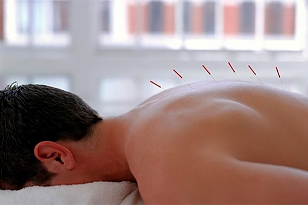 acupunturismo para dores nas costas