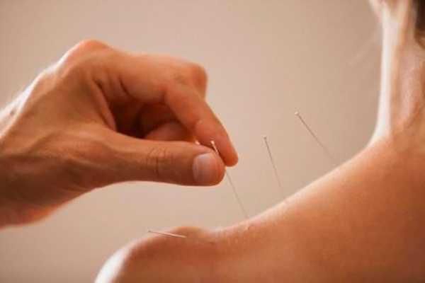 acupunturismo para dores musculares